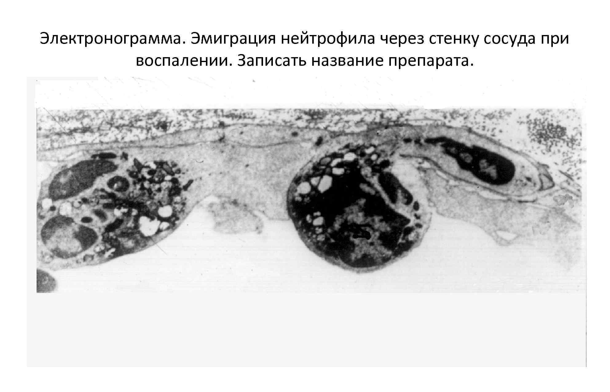 Электронограмма. Эмиграция нейтрофила через стенку сосуда при воспалении. Записать название препарата. 