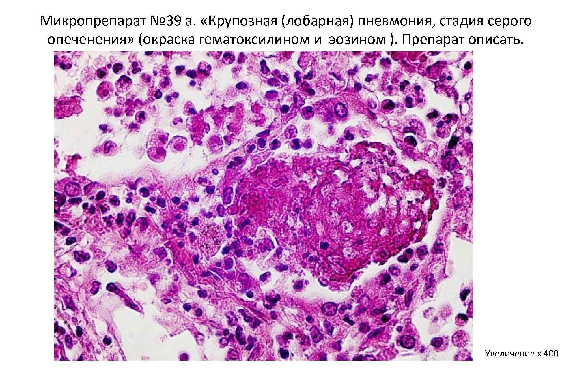 Крупозный трахеит микропрепарат рисунок