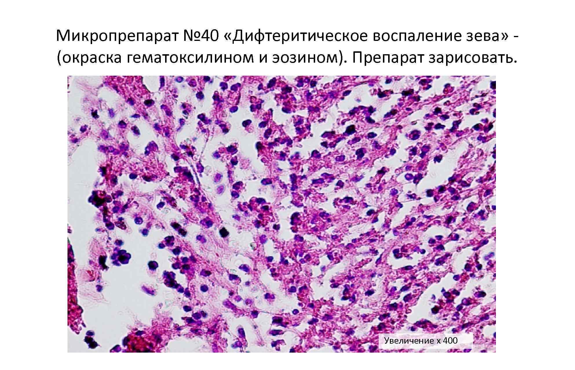 Описание микропрепарата. Дифтеритический колит микропрепарат. Дифтерическое воспаление микропрепарат. Морфология дифтерического воспаления. Дмфтерическмй колит микропрепарат.