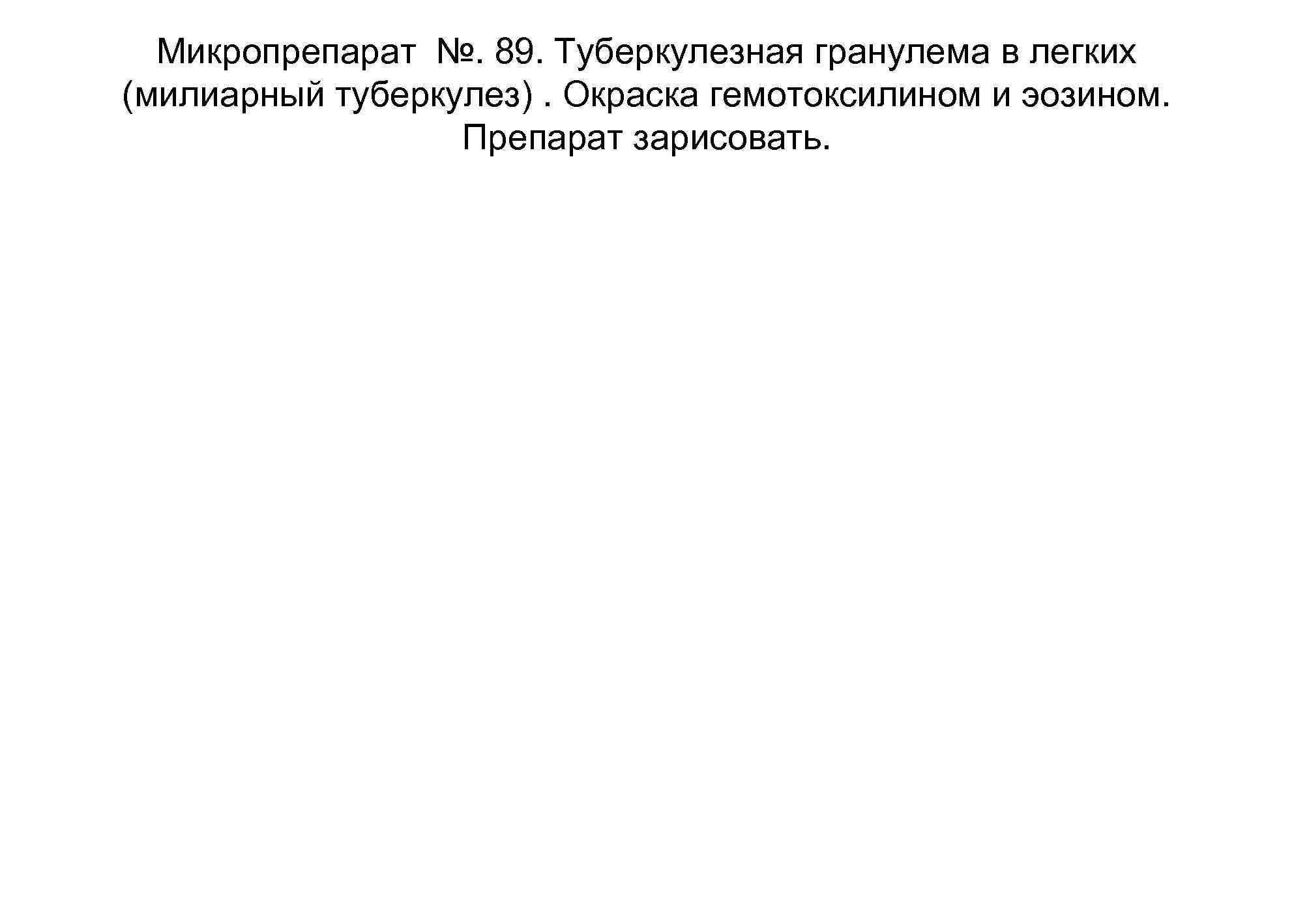  Микропрепарат №. 89. Туберкулезная гранулема в легких (милиарный туберкулез). Окраска гемотоксилином и эозином.