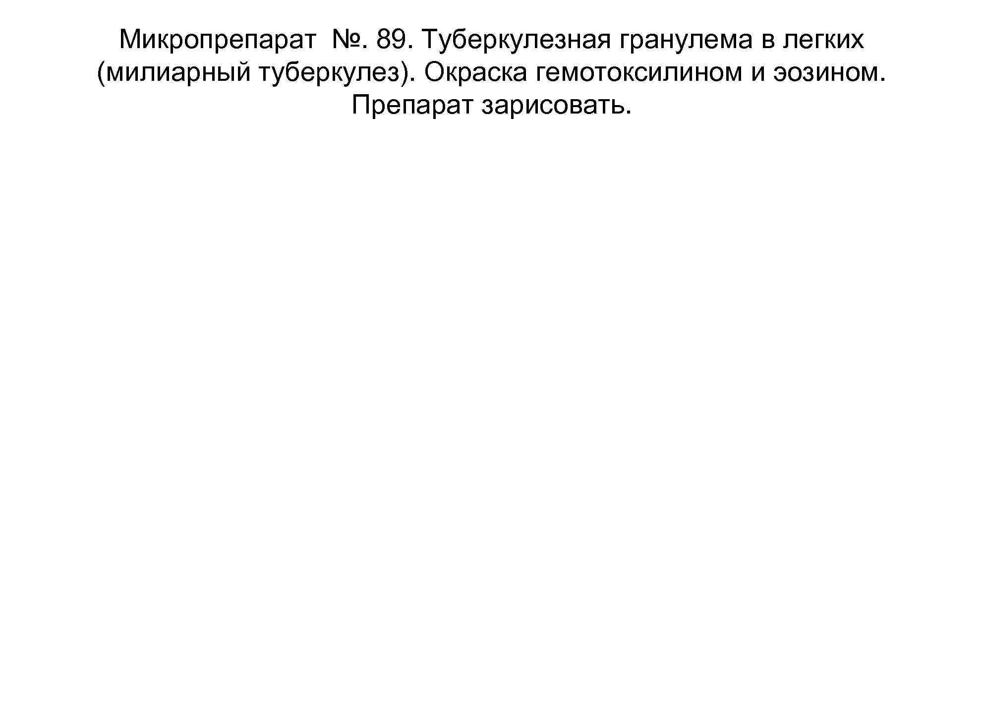  Микропрепарат №. 89. Туберкулезная гранулема в легких (милиарный туберкулез). Окраска гемотоксилином и эозином.