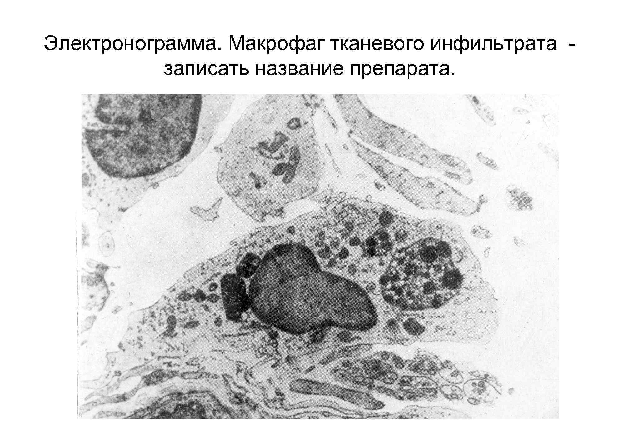 Солитарная гумма печени микропрепарат рисунок