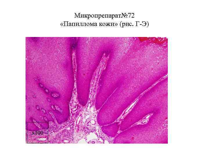  Микропрепарат№ 72 «Папиллома кожи» (рис. Г-Э) x 100 