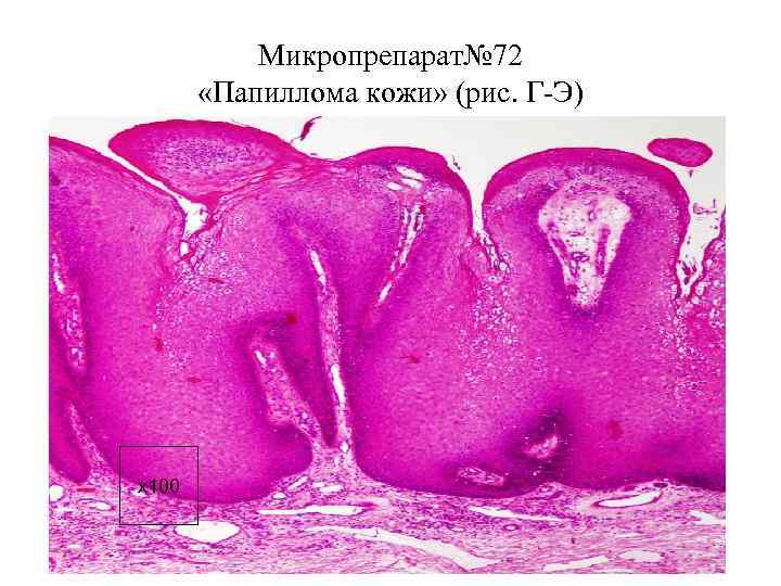 Микропрепарат папиллома кожи рисунок