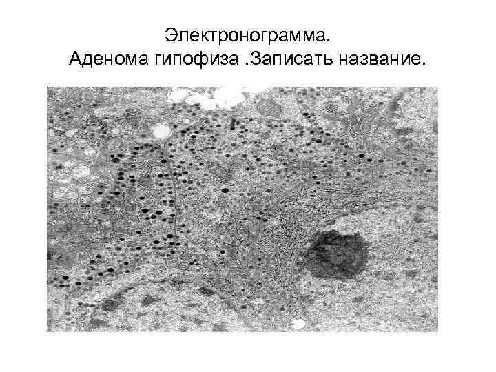  Электронограмма. Аденома гипофиза. Записать название. 