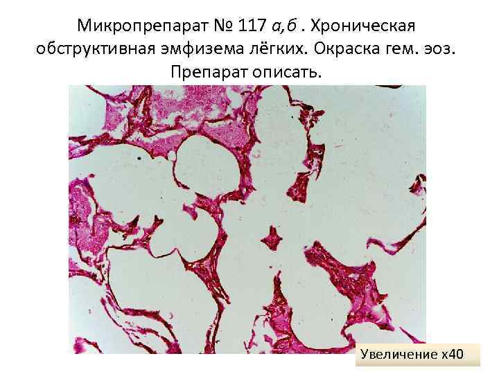   Микропрепарат № 117 а, б. Хроническая обструктивная эмфизема лёгких. Окраска гем. эоз.