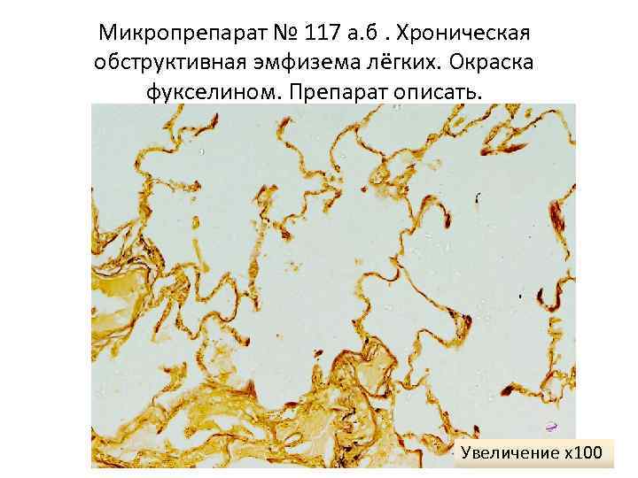 Микропрепарат № 117 а. б. Хроническая обструктивная эмфизема лёгких. Окраска фукселином. Препарат описать. 