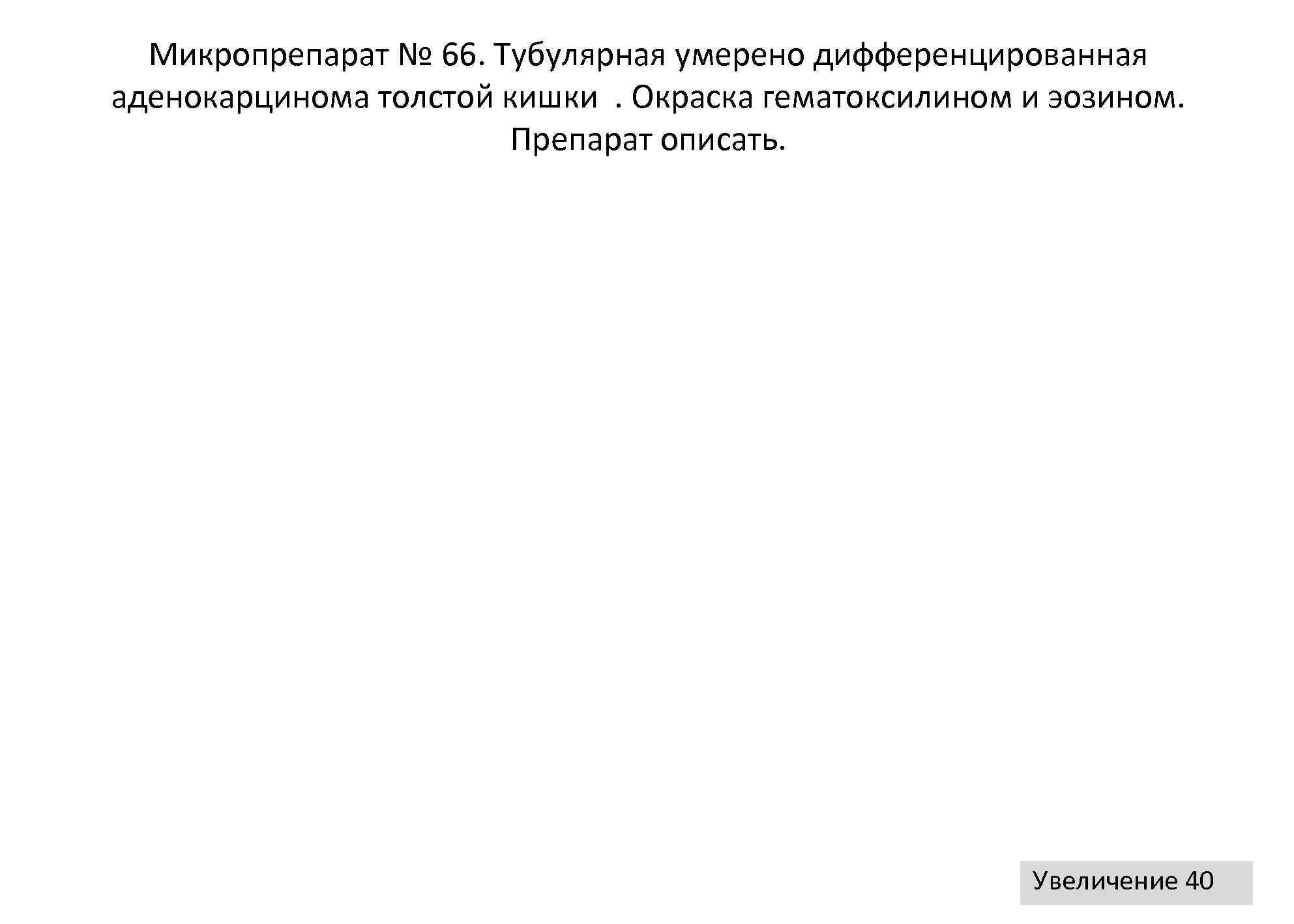  Микропрепарат № 66. Тубулярная умерено дифференцированная аденокарцинома толстой кишки. Окраска гематоксилином и эозином.