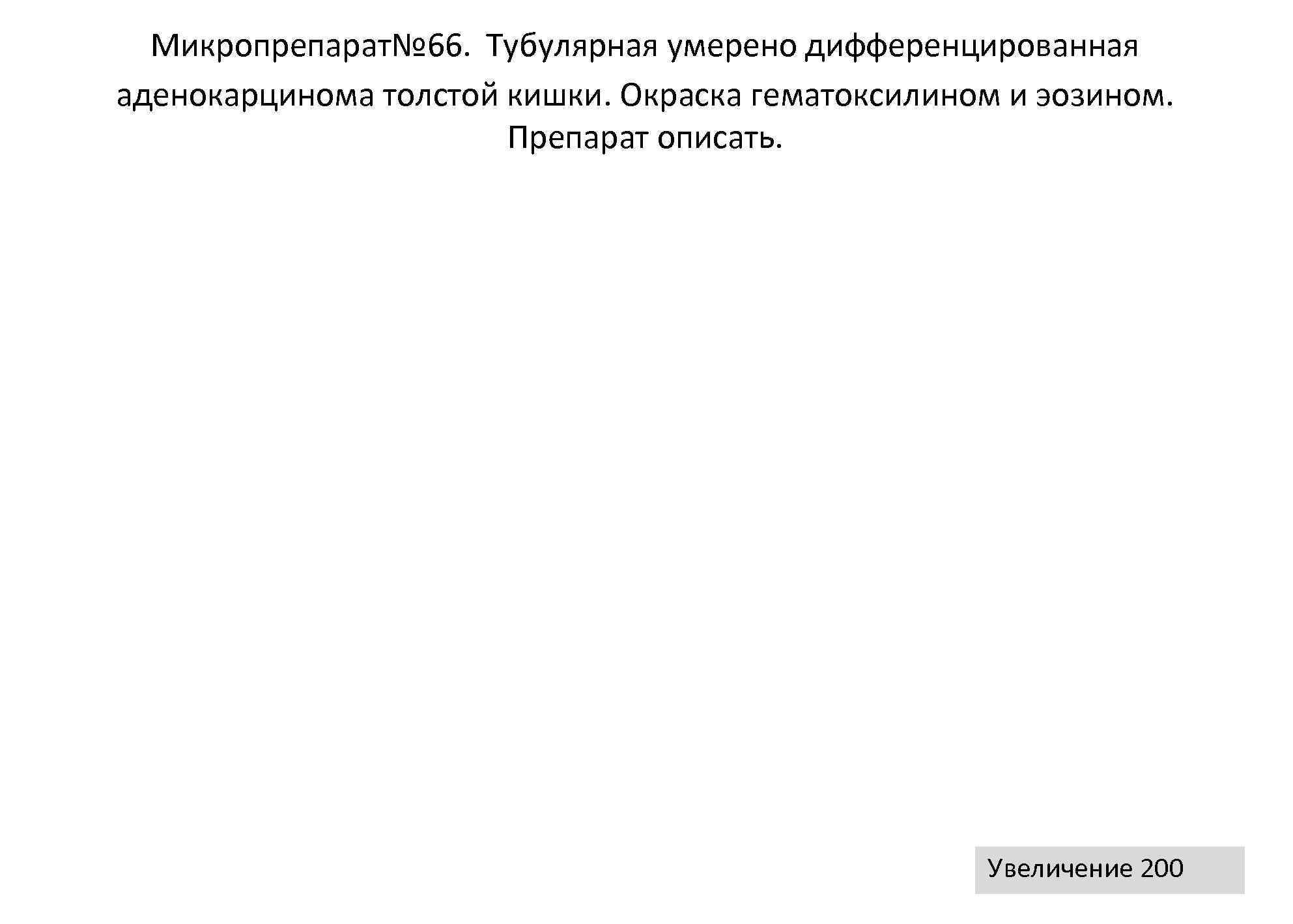 Микропрепарат№ 66. Тубулярная умерено дифференцированная аденокарцинома толстой кишки. Окраска гематоксилином и эозином. 