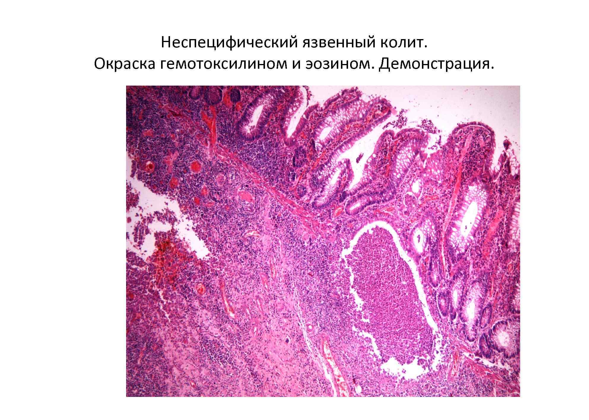   Неспецифический язвенный колит. Окраска гемотоксилином и эозином. Демонстрация. 