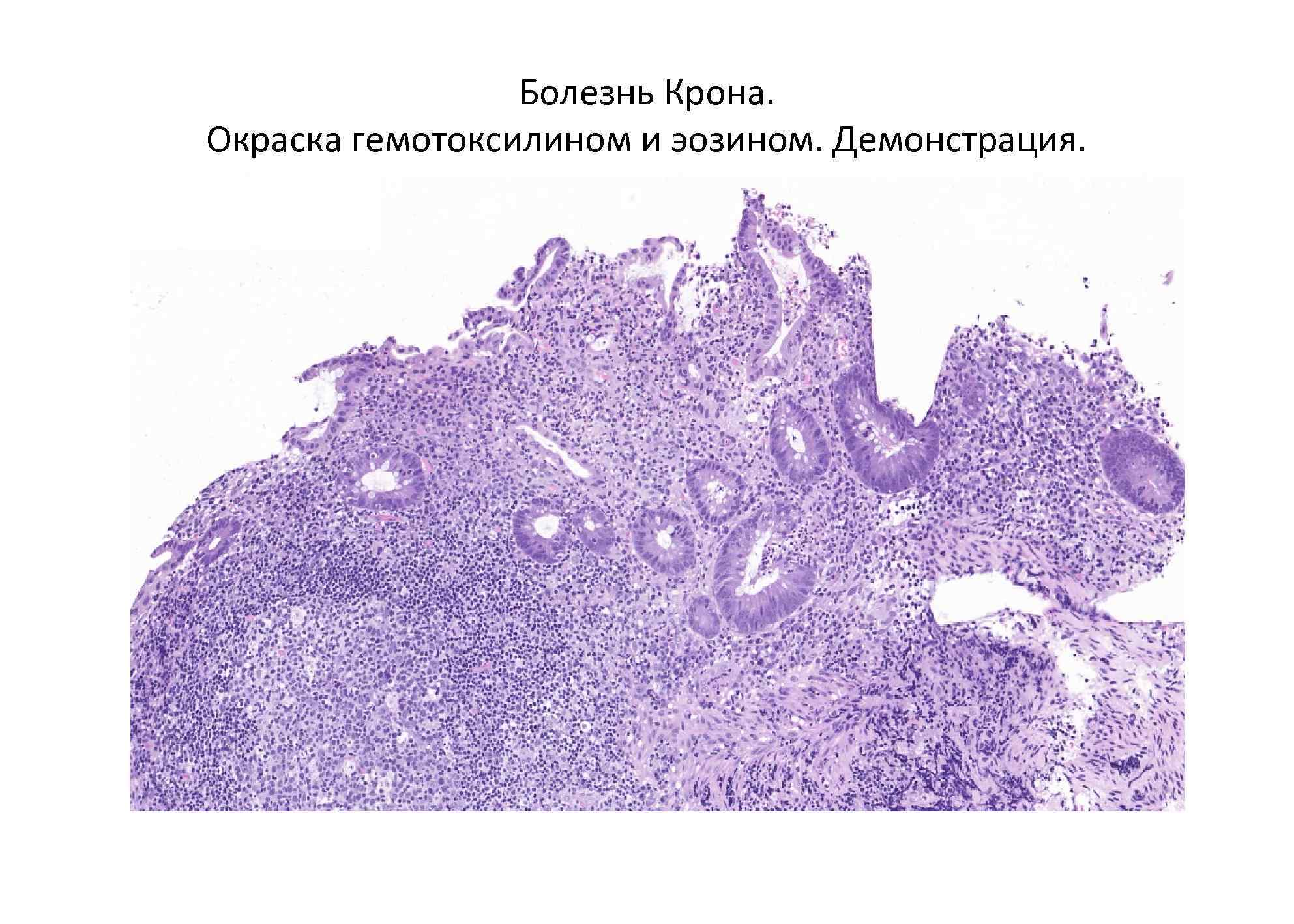    Болезнь Крона. Окраска гемотоксилином и эозином. Демонстрация. 
