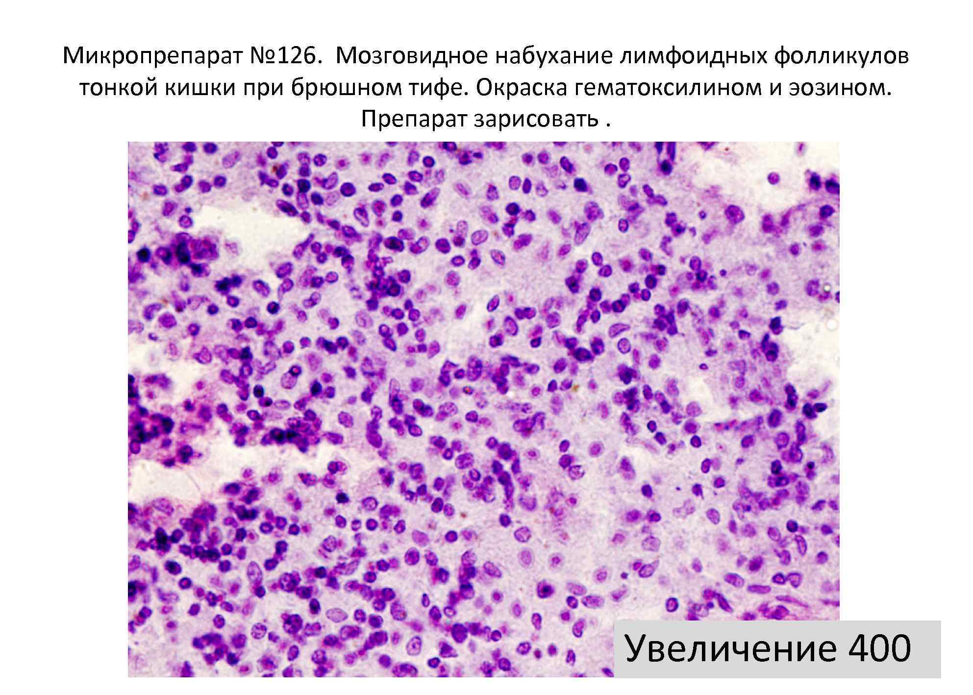 Микропрепарат № 126. Мозговидное набухание лимфоидных фолликулов тонкой кишки при брюшном тифе. Окраска гематоксилином