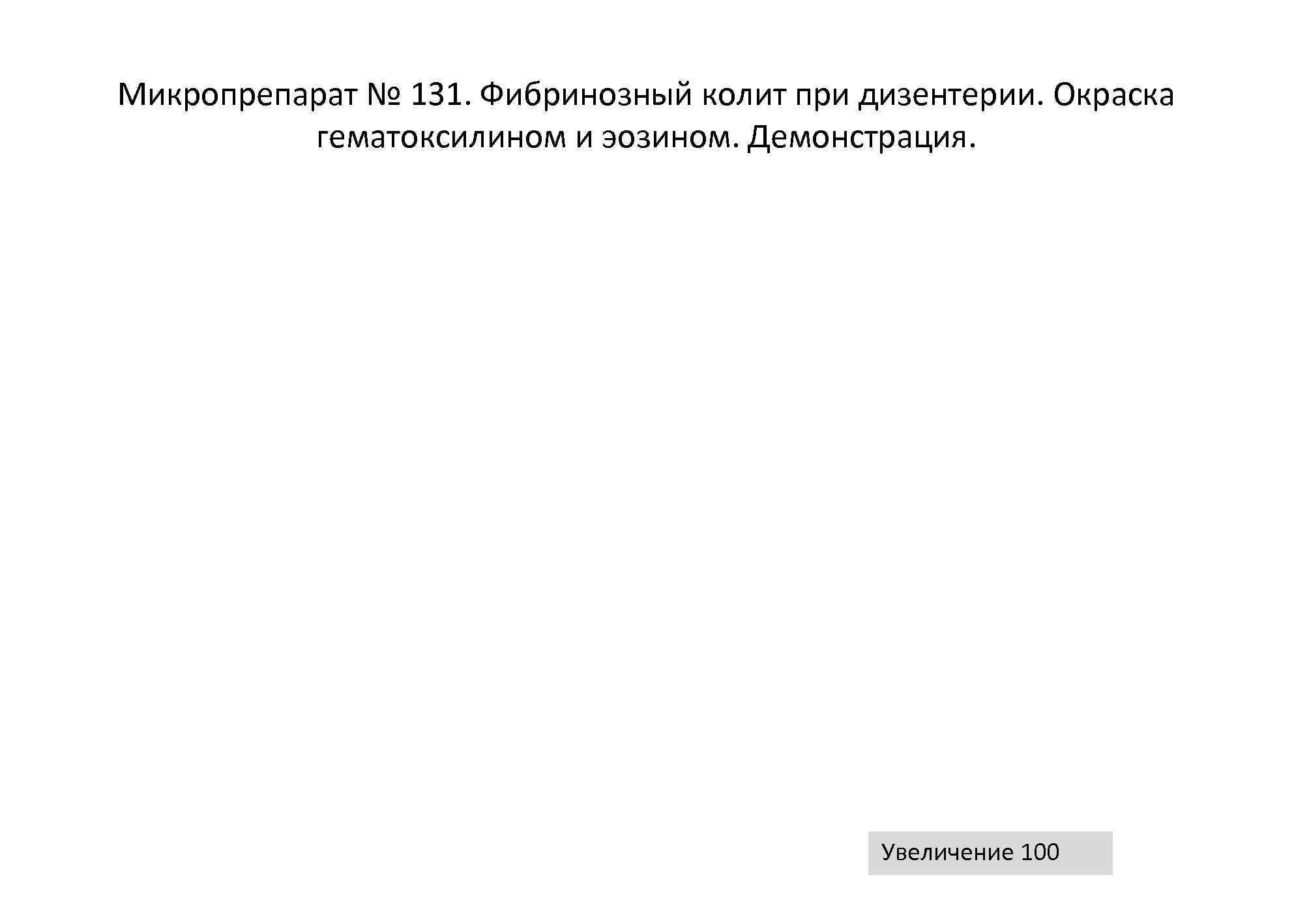 Микропрепарат № 131. Фибринозный колит при дизентерии. Окраска  гематоксилином и эозином. Демонстрация. 