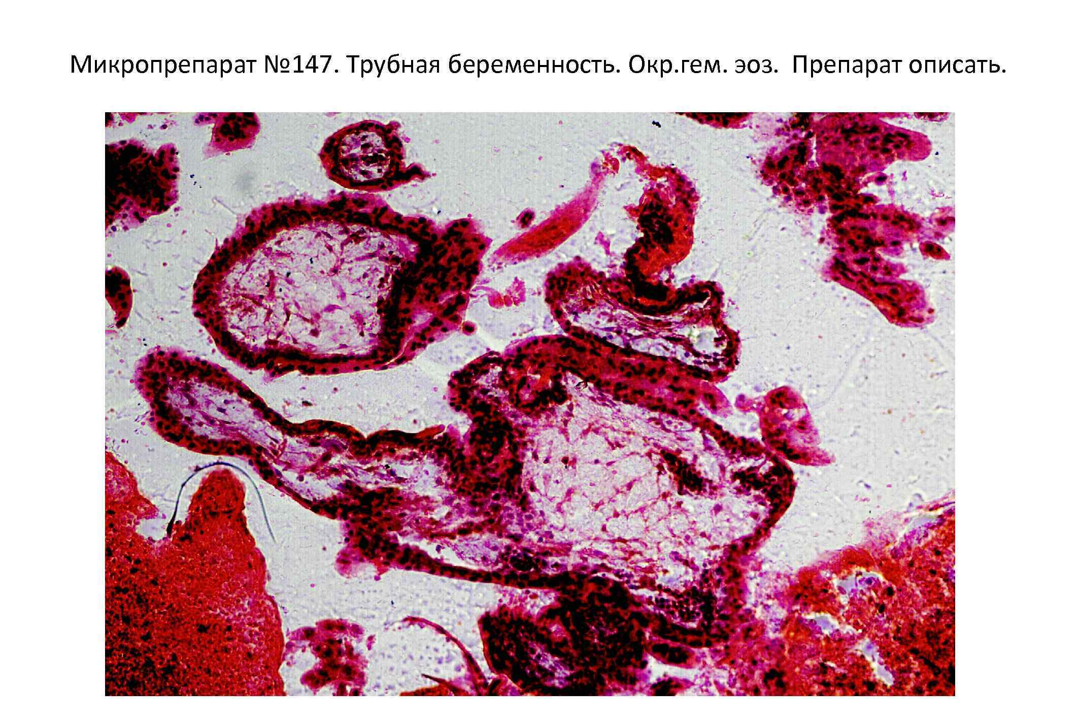 Что такое эндоцервикоз. Микропрепарат Трубная беременность патанатомия. Трубная беременность патологическая анатомия микропрепараты. Трубная беременность препарат патанатомия. Трубная беременность гистология.