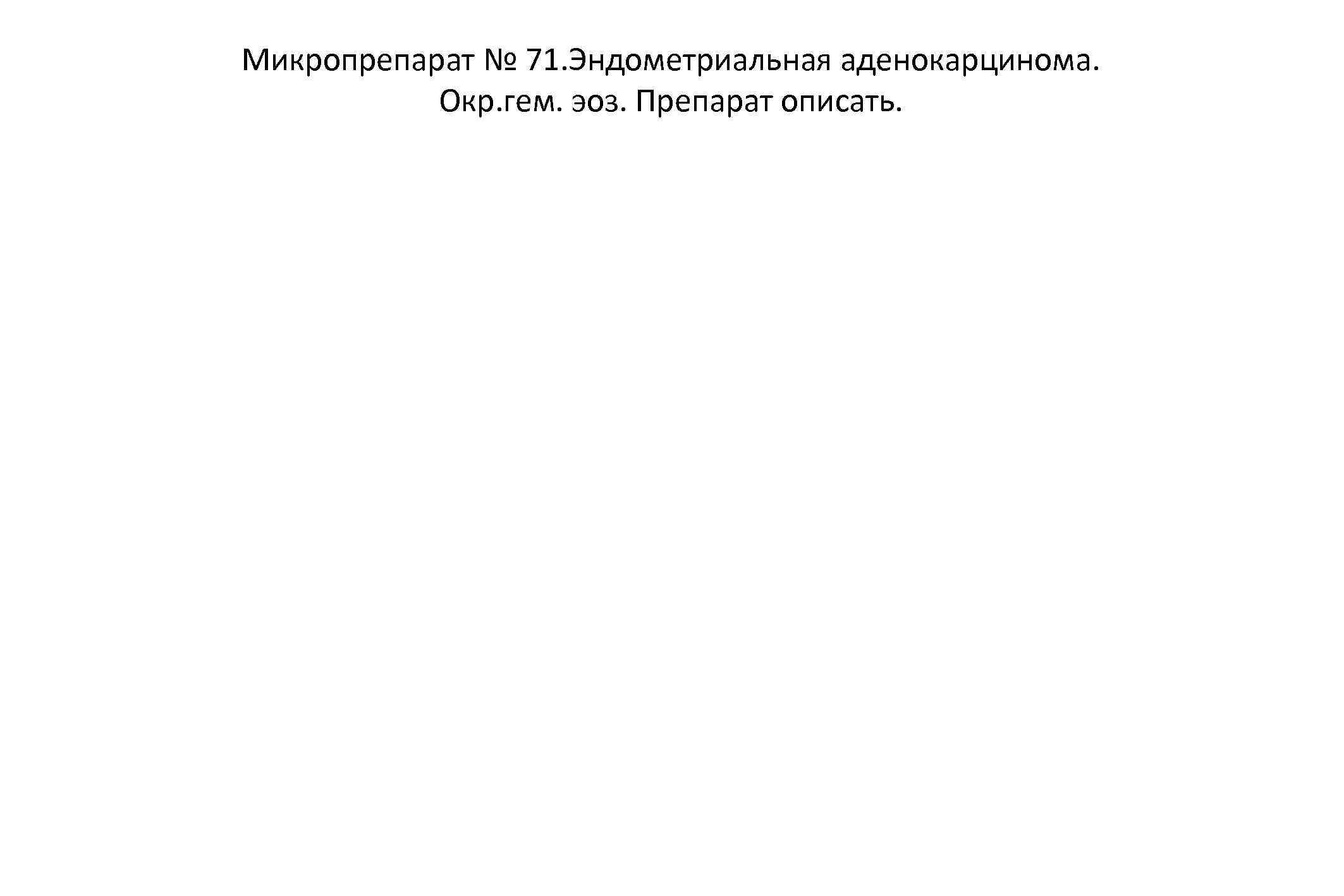 Микропрепарат № 71. Эндометриальная аденокарцинома. Окр. гем. эоз. Препарат описать. 