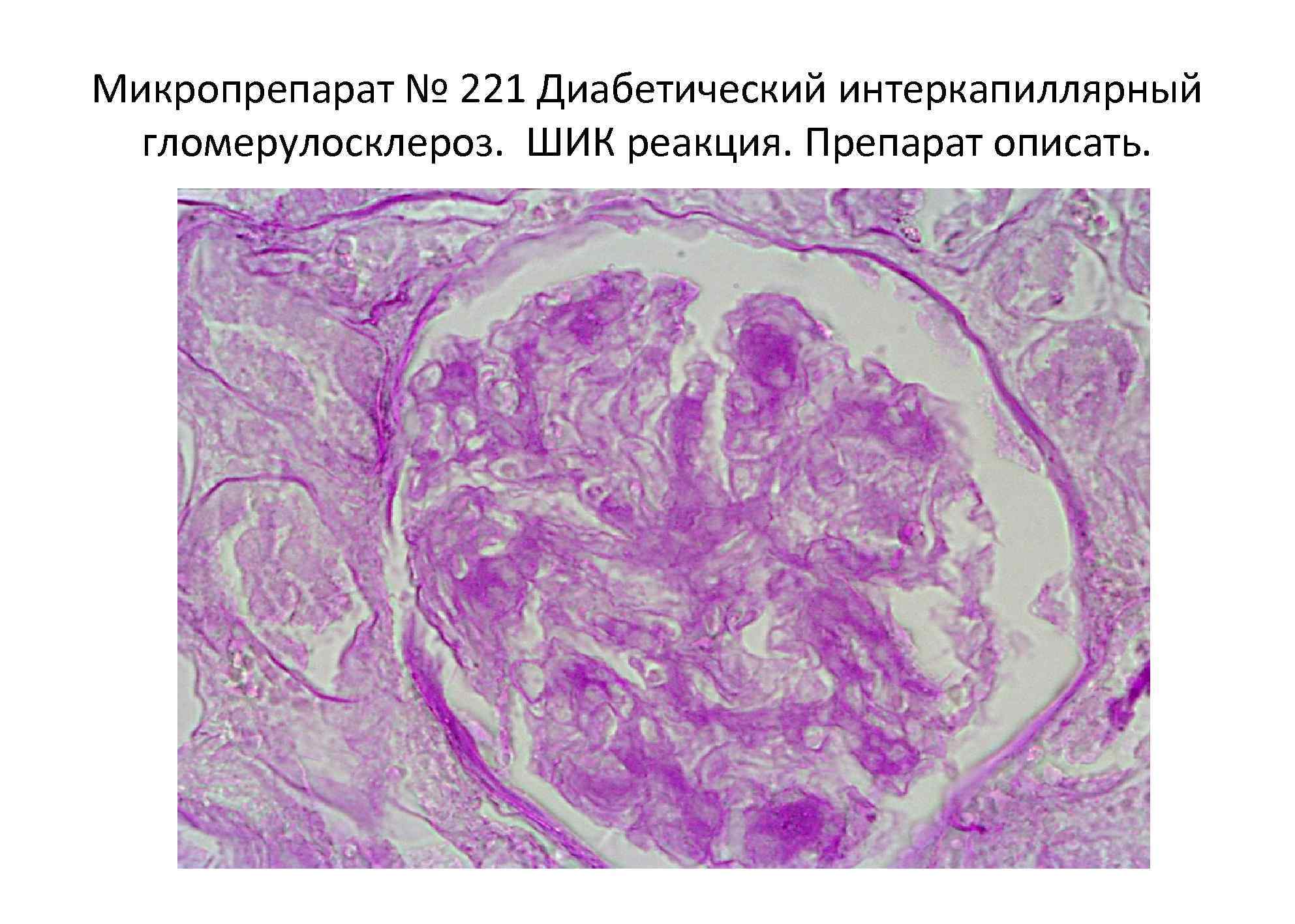 Микропрепарат № 221 Диабетический интеркапиллярный гломерулосклероз. ШИК реакция. Препарат описать. 