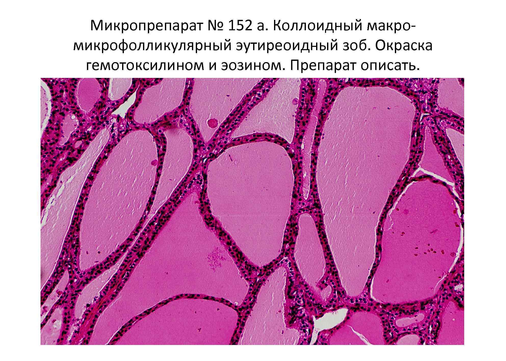 Диффузная ткань. Коллоидный зоб макропрепарат. Макрофолликулярный коллоидный зоб микропрепарат. Коллоидная Струма микропрепарат. Коллоидный зоб микропрепарат.