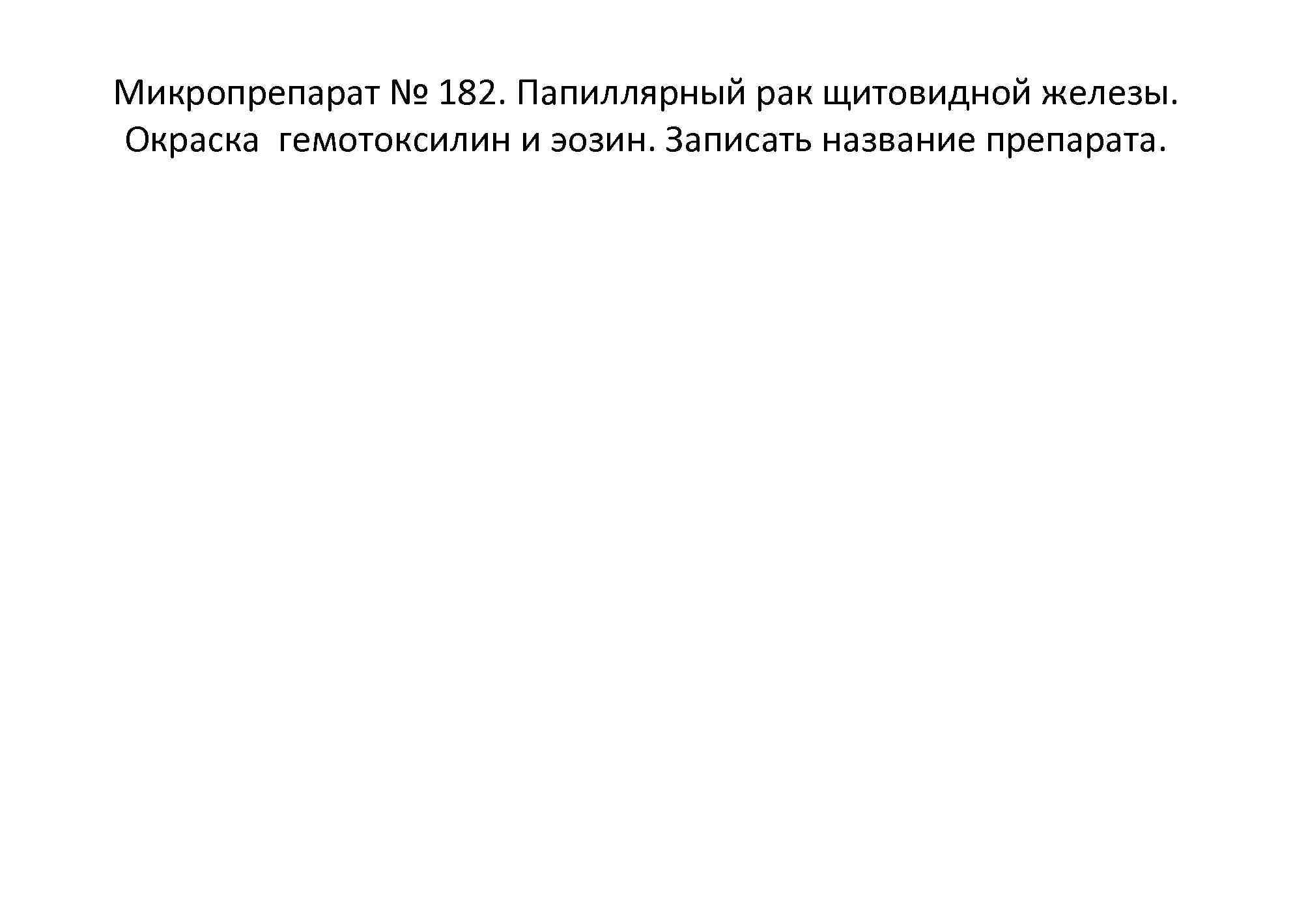 Микропрепарат № 182. Папиллярный рак щитовидной железы. Окраска гемотоксилин и эозин. Записать название препарата.