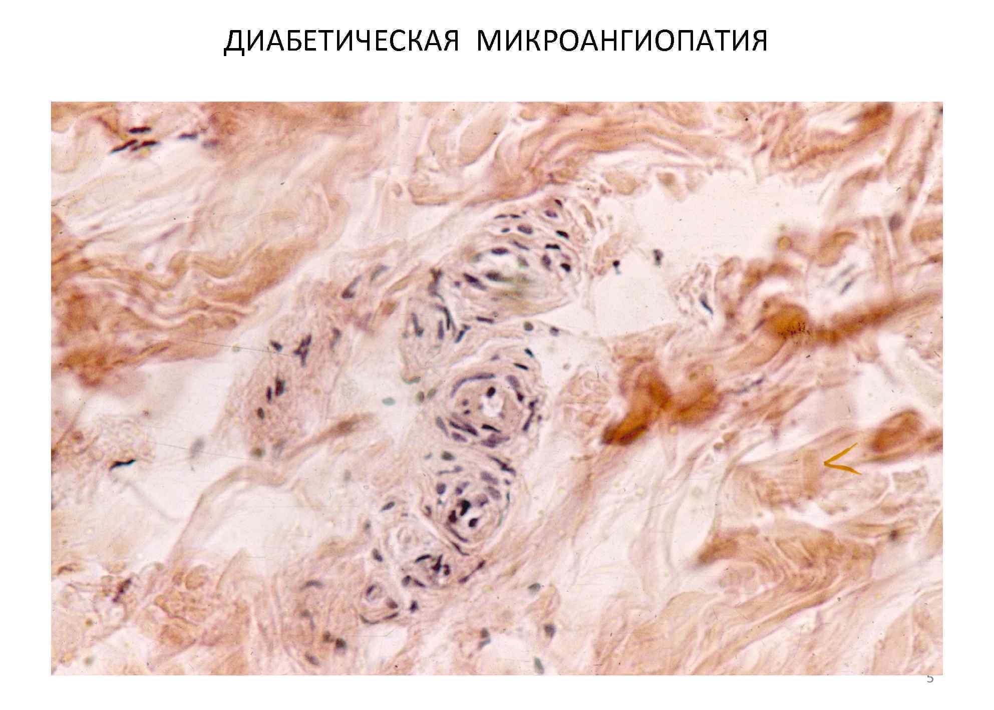 Диабетическая микроангиопатия. Диабетическая микроангиопатия гистология. Диабетическая макроангиопатия патологическая анатомия. Микроангиопатия гистология. Диабетическая микроангиопатия микропрепарат.