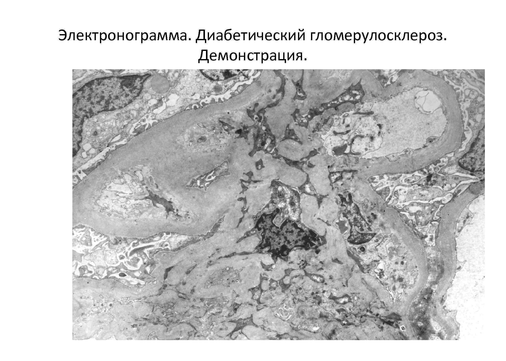 Электронограмма. Диабетический гломерулосклероз. Демонстрация. 