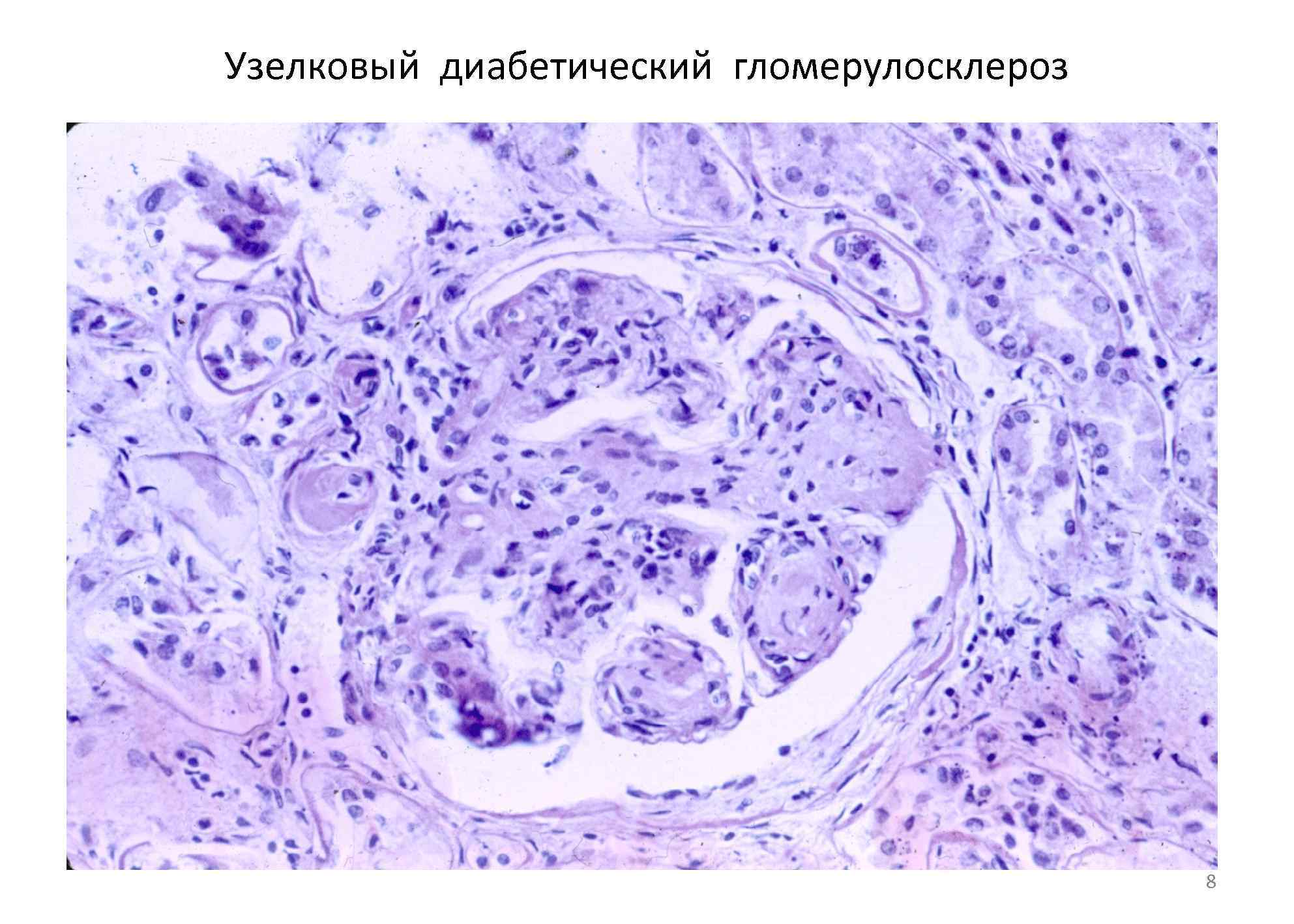 Узелковый диабетический гломерулосклероз 8 