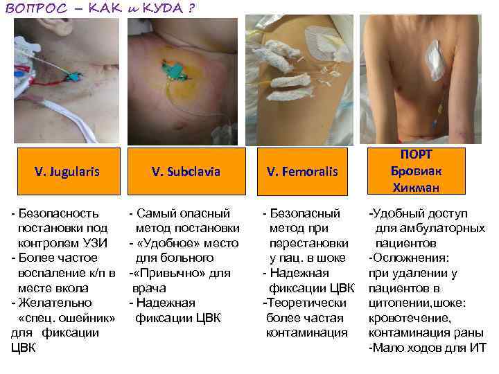 ВОПРОС – КАК и КУДА ? ПОРТ V. Jugularis V. Subclavia V. Femoralis Бровиак