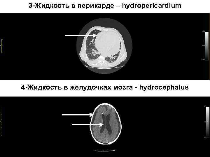  3 -Жидкость в перикарде – hydropericardium 4 -Жидкость в желудочках мозга - hydrocephalus