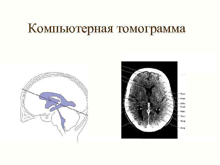 Компьютерная томограмма 