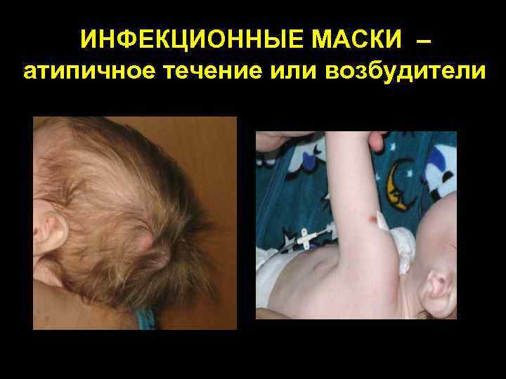  ИНФЕКЦИОННЫЕ МАСКИ – атипичное течение или возбудители ТКИН 