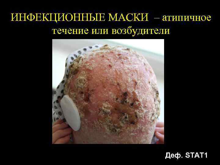 ИНФЕКЦИОННЫЕ МАСКИ – атипичное течение или возбудители Деф. STAT 1 