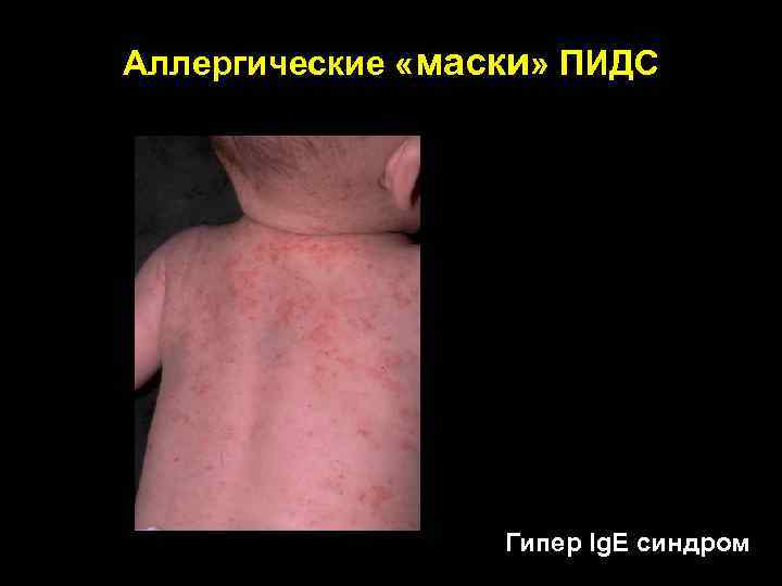 Аллергические «маски» ПИДС Гипер Ig. E синдром 