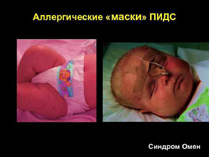 Аллергические «маски» ПИДС Синдром Омен 