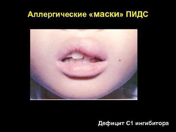 Аллергические «маски» ПИДС Дефицит С 1 ингибитора 