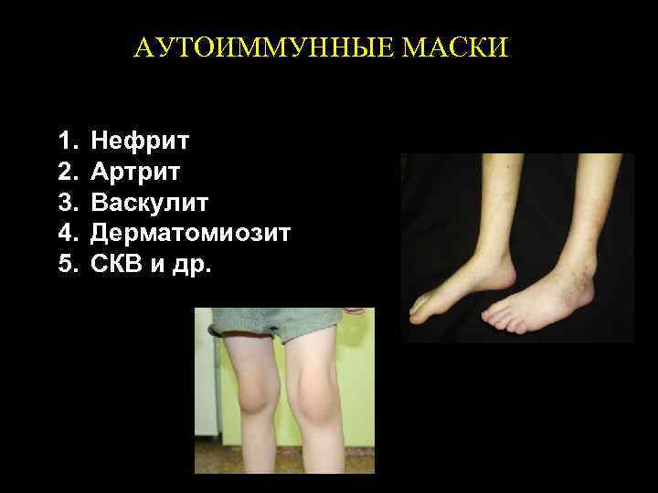  АУТОИММУННЫЕ МАСКИ 1. Нефрит 2. Артрит 3. Васкулит 4. Дерматомиозит 5. СКВ и