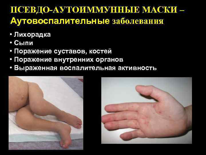 ПСЕВДО-АУТОИММУННЫЕ МАСКИ – Аутовоспалительные заболевания • Лихорадка • Сыпи • Поражение суставов, костей •