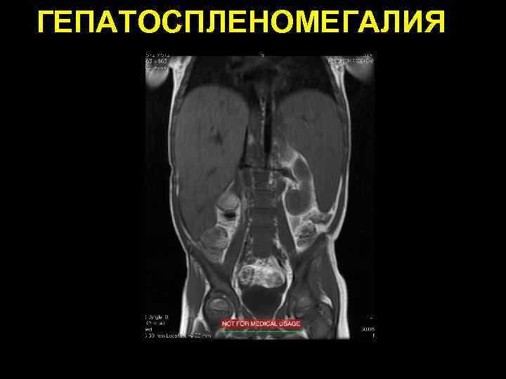 ГЕПАТОСПЛЕНОМЕГАЛИЯ 