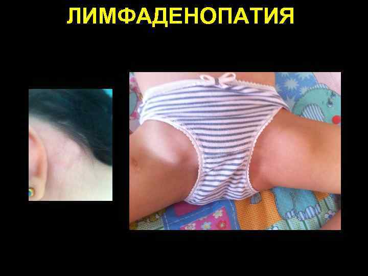 ЛИМФАДЕНОПАТИЯ 
