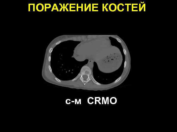 ПОРАЖЕНИЕ КОСТЕЙ с-м СRMO 