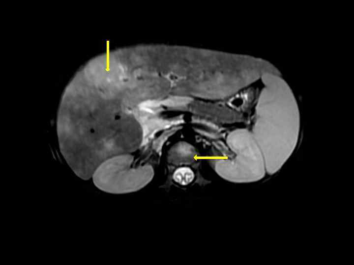 МРТ: Крупный очаг в печени, который биопсировали, а 
