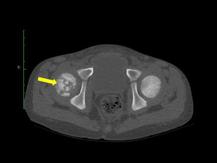 МРТ: Поражение головки бедренной 