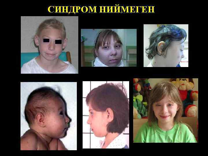 СИНДРОМ НИЙМЕГЕН 