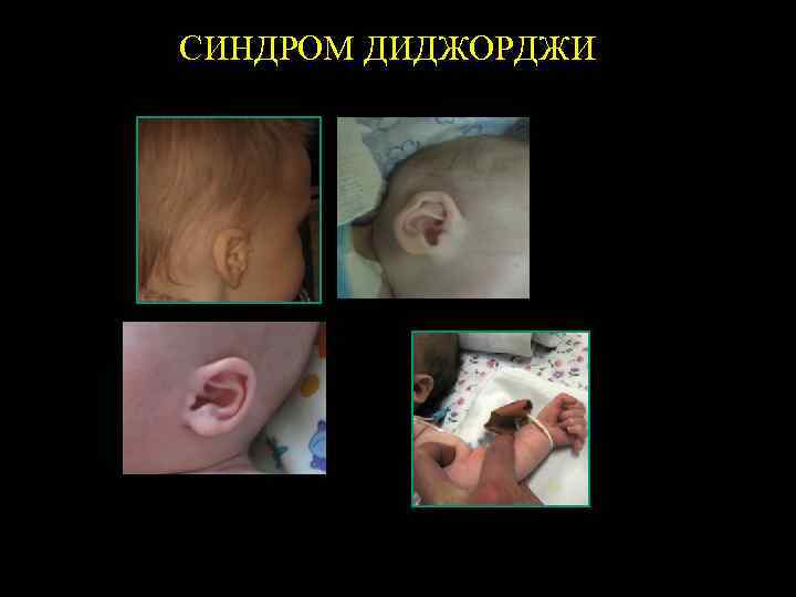 СИНДРОМ ДИДЖОРДЖИ 