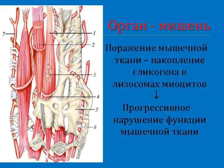 Орган - мишень Поражение мышечной ткани – накопление гликогена в лизосомах миоцитов Прогрессивное нарушение