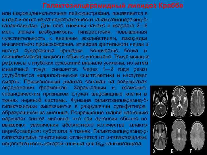  Галактозилцерамидный липидоз Краббе или шаровидно клеточная лейкодистрофия, проявляется в младенчестве из за недостаточности