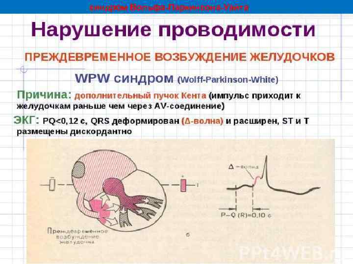 синдром Вольфа-Паркинсона-Уайта 