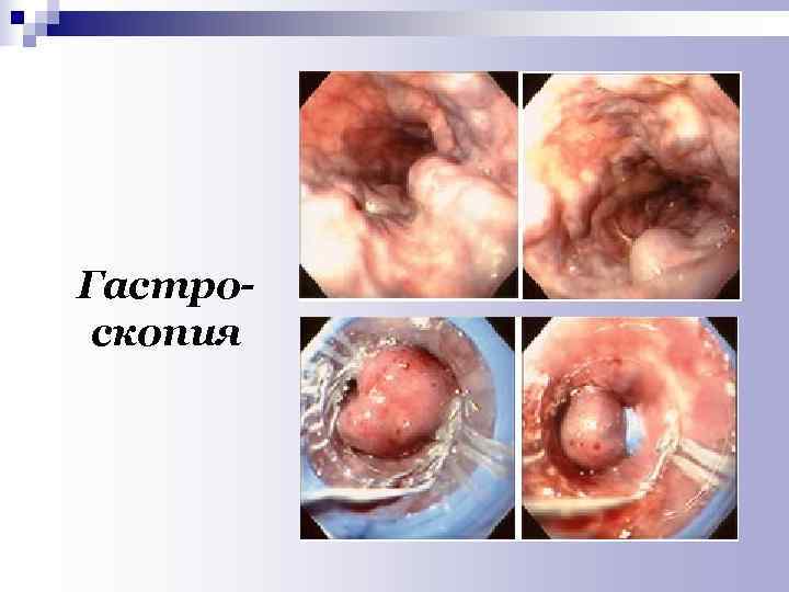 Гастро- скопия 
