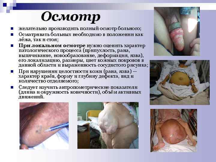  Осмотр n желательно производить полный осмотр больного; n Осматривать больных необходимо в положении