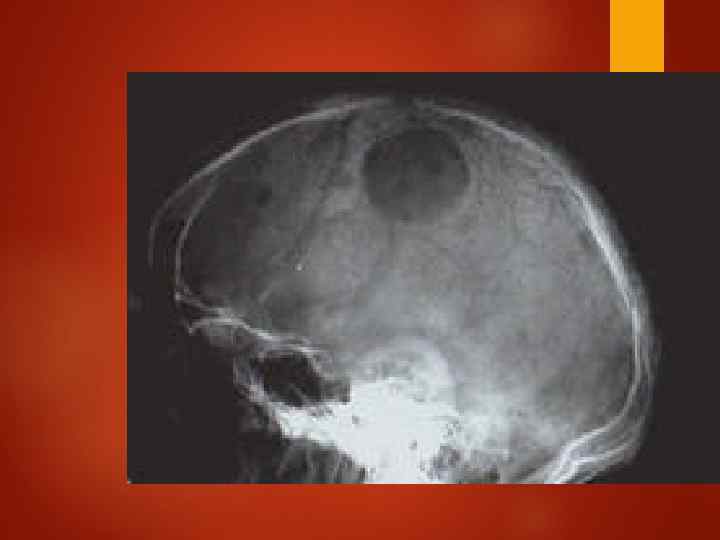 Плазмацитома черепа 