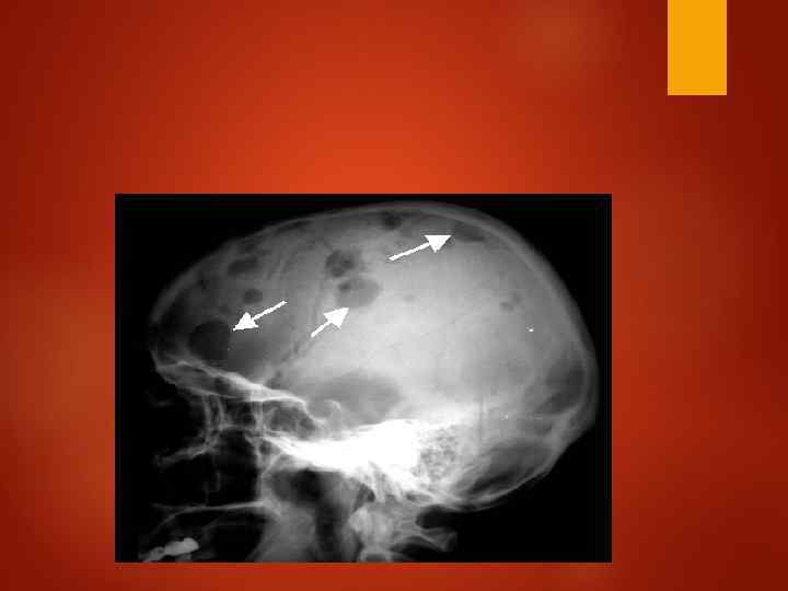 Клиническое наблюдение Женщина 42 -х лет обратилась с жалобой на безболезненное образование на черепе