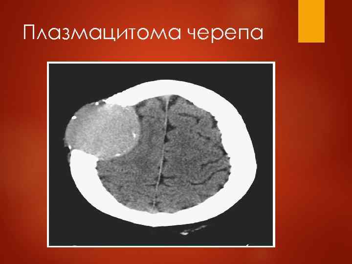 Опухолевый узел 